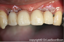 dental-implant-lee-soon-boon-dentistsnearby2