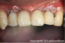 绑牙 . Conventional and Self-Ligating Braces . Pendakap Gigi . Ortho –  DENTIST3 – Dentist3