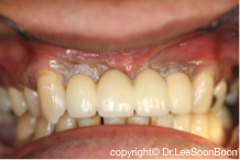 9 Most Common Questions About Dental Implants Dental Clinics Dentists Klinik Gigi 牙医 In Malaysia