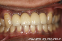 dental-implant-lee-soon-boon-dentistsnearby7