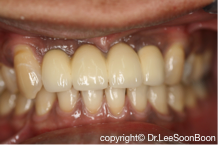 绑牙 . Conventional and Self-Ligating Braces . Pendakap Gigi . Ortho –  DENTIST3 – Dentist3