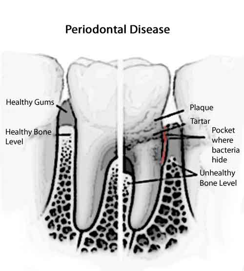 pulling gum oil disease gums periodontal teeth diagram away health dental pull diseases care bone fall shift loose dentistsnearby oral