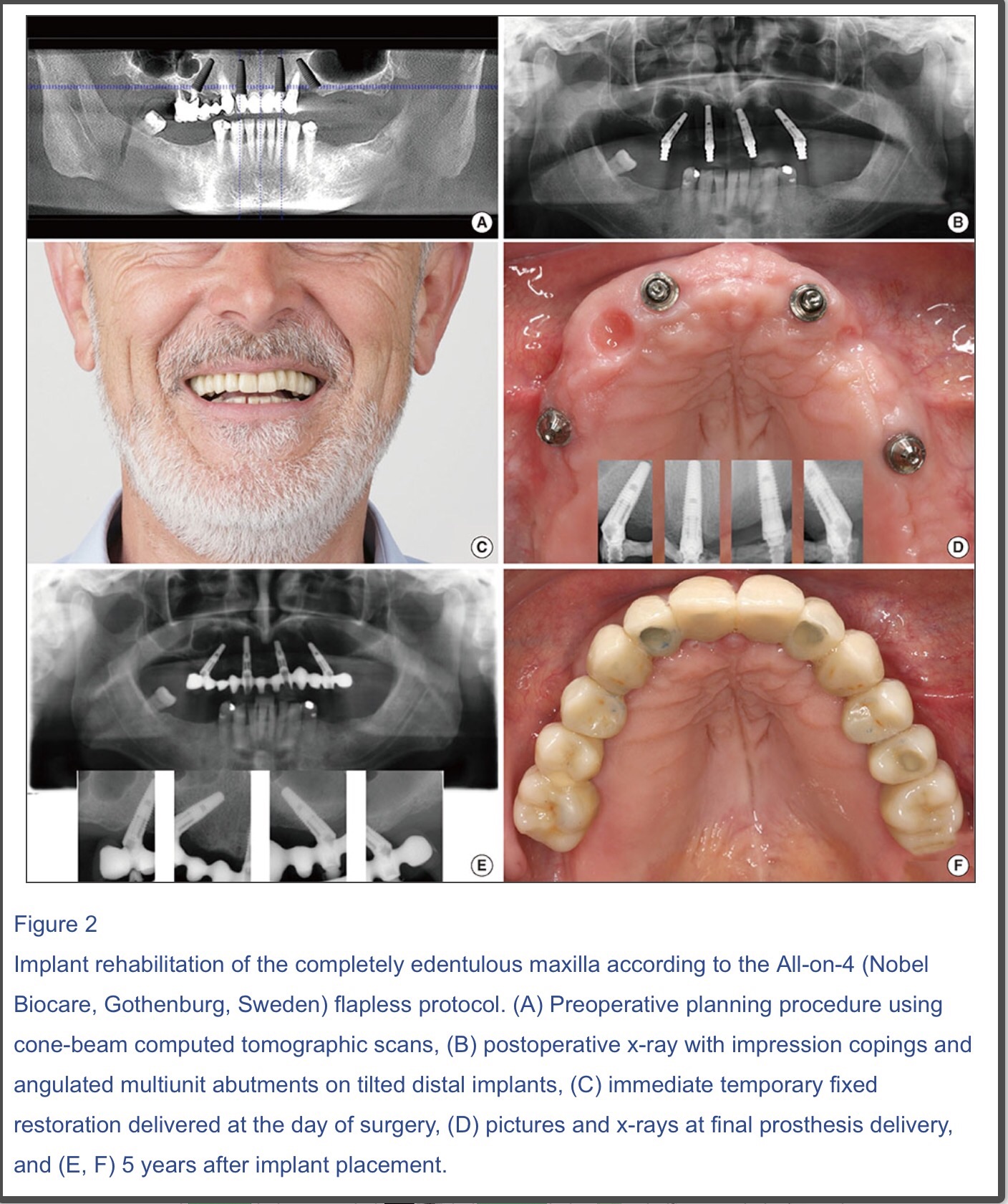 immediate-implants-dr-kam-dentistsnearby