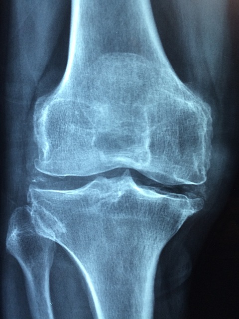 osteoporosis-dentistsnearby